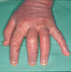 Hævet hånd med eksem på håndryggen