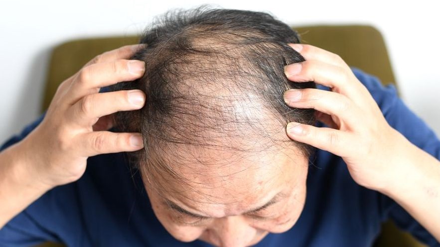 Hårtab Hentehår Istock 1691995196 (1)