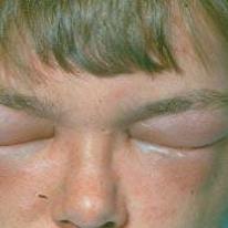 Hævelse og rødme i ansigtet efter hvepsestik