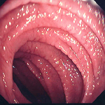 Endoskopi af tyndtarm ved cøliaki