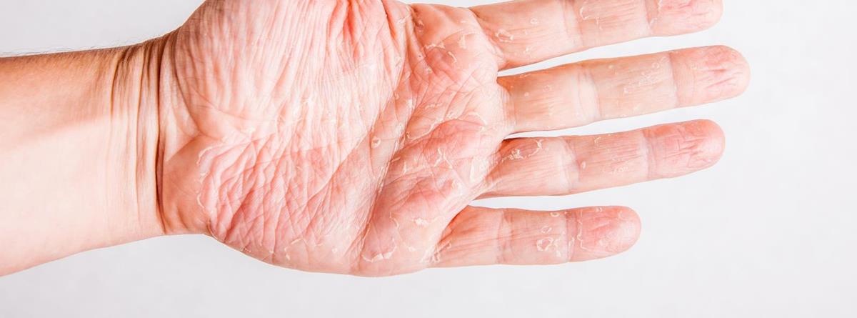 eksem på hænder