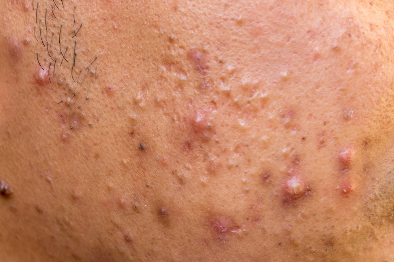 Acne Bumser Mand Istock 849986310