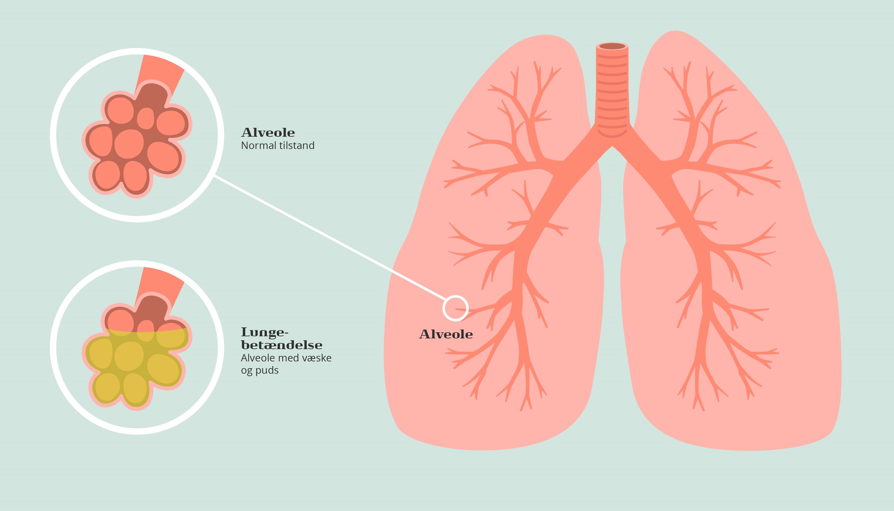 Lungebetaendelse Illustration Stor