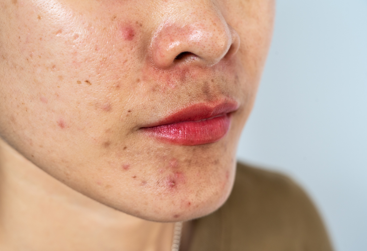 Acne Bumser Hage Næse Istock 1402032343