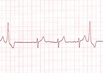 EKG med illustration af ekstrasystole og udeblevet hjerteslag