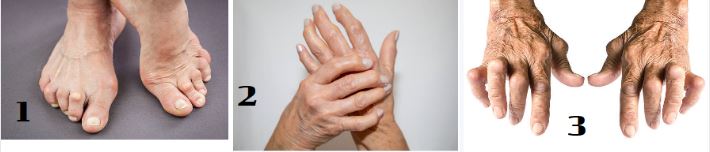 Leddegigt