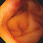 Endoskopi af rask tyndtarm