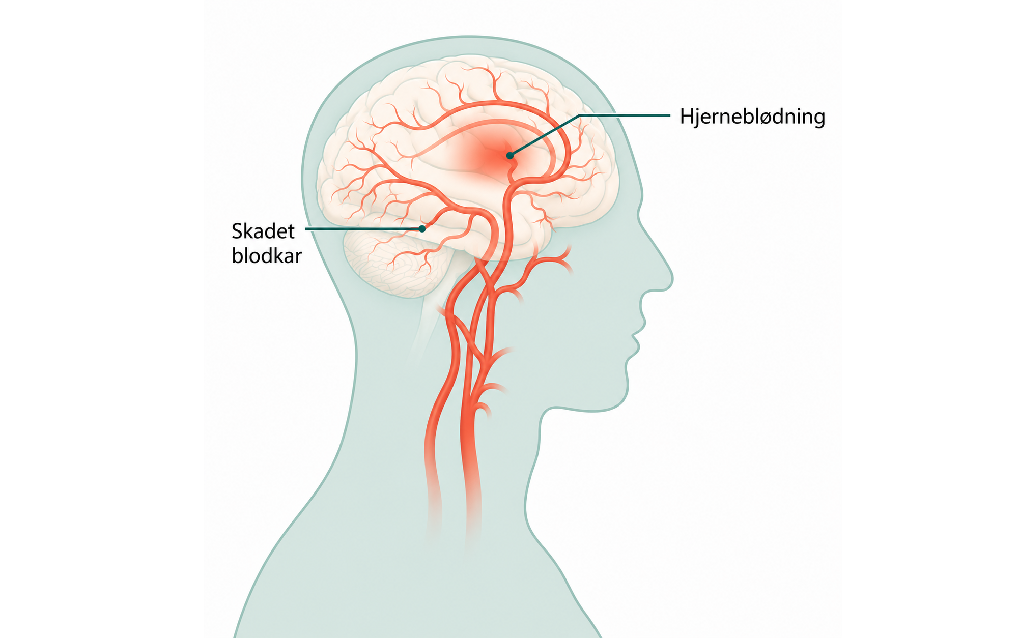 Illustration af hjerneblødning 