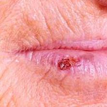 Sår på underlæbe efter herpesudbrud