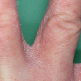 Håndeksem mellem fingrene