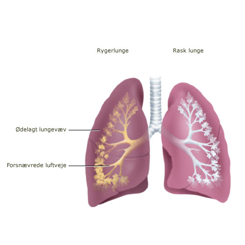 Rygning ødelægger lungevæv og kan føre til forsnævrede luftveje