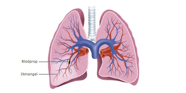 Illustration af blodprop i lunge