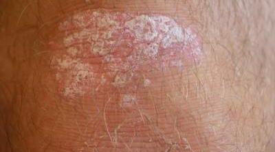 Psoriasis