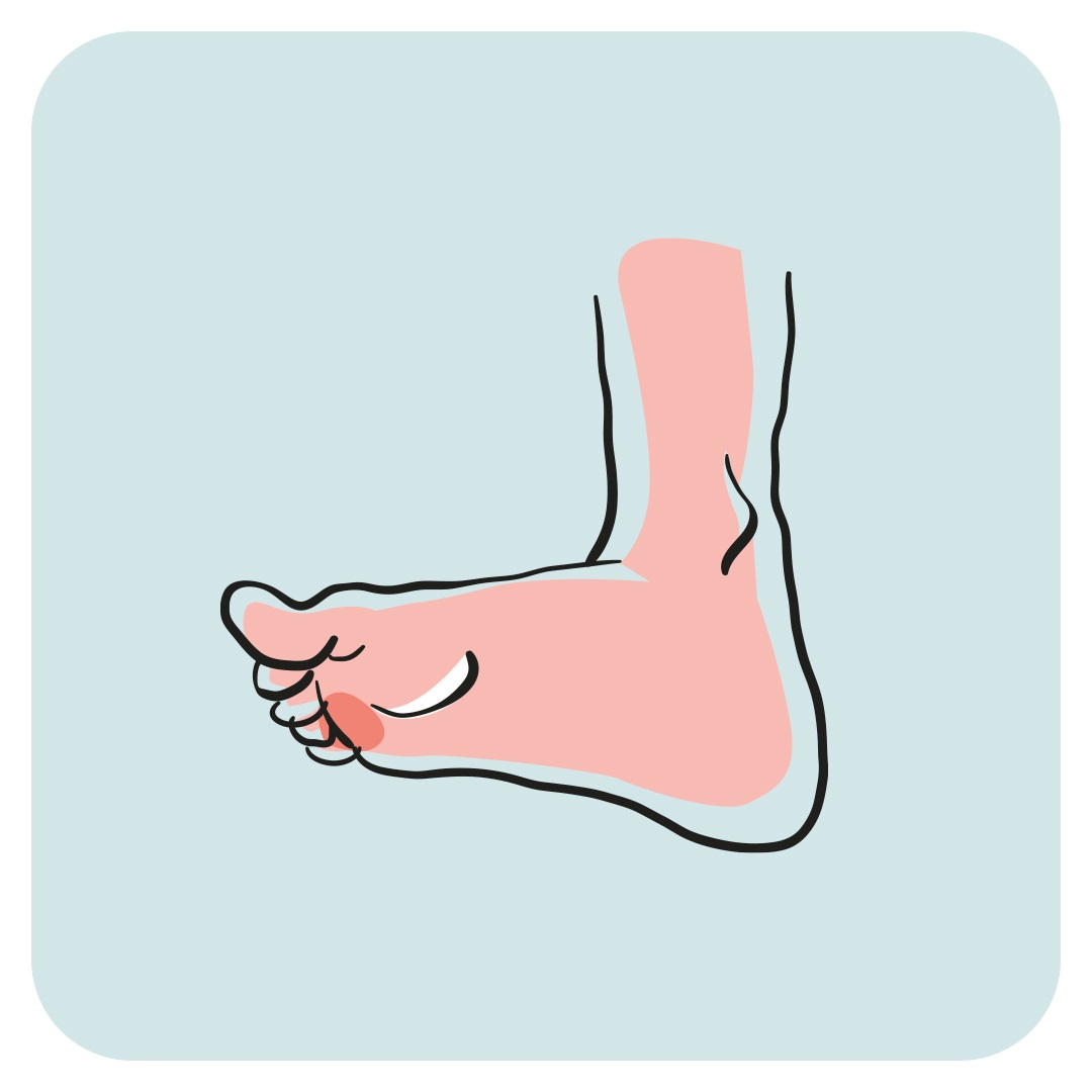 Illustration Af Fodsvamp Kvadrat