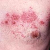 Rødme og blærer på brystet efter udbrud af helvedesild