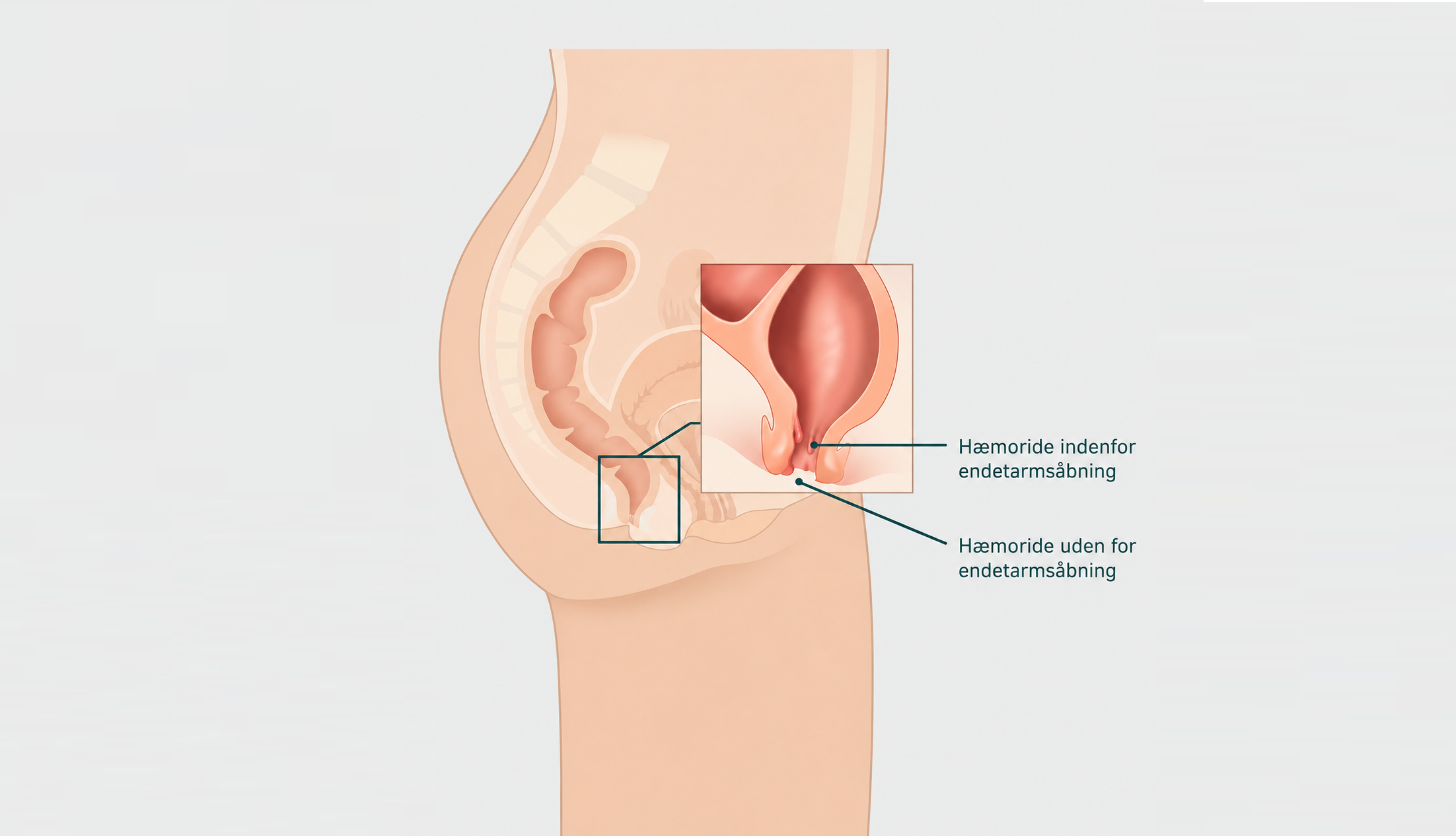 Illustration af hæmoride