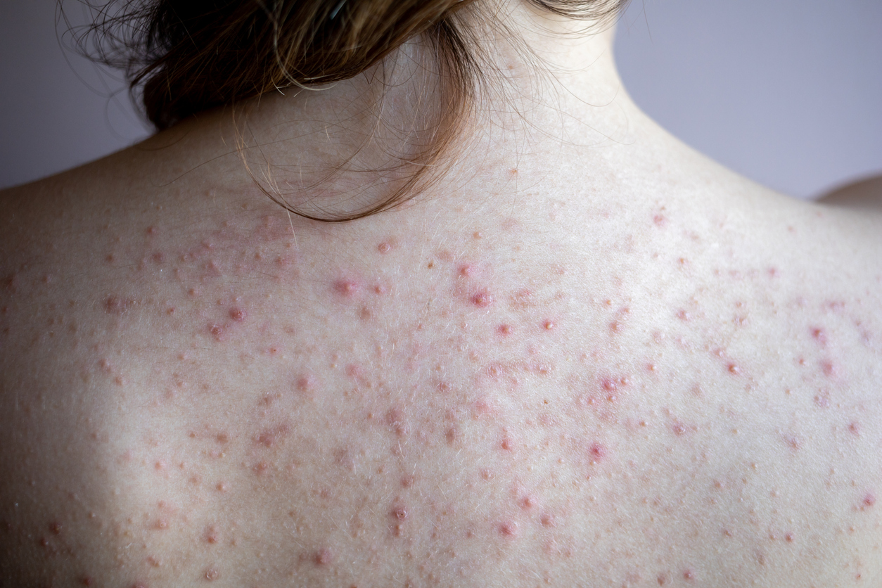 Acne Ryg Kvinde Istock 1287511575