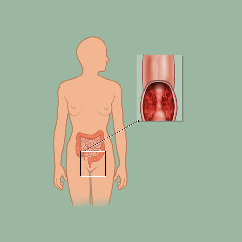 Forsmævring af tarme efter tarmkræft og stop for luftgang