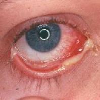 Eksempel på øjenbetændelse