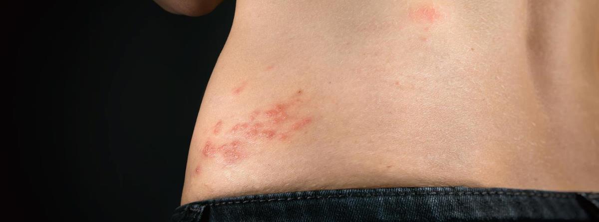 helvedesild-herpes-zoster-istock-1356087717.jpg