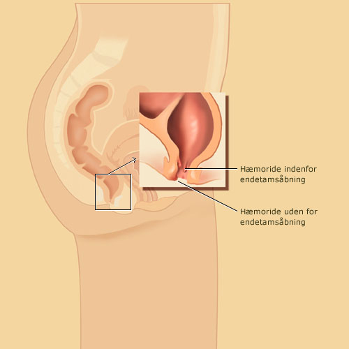 haemorider.jpg