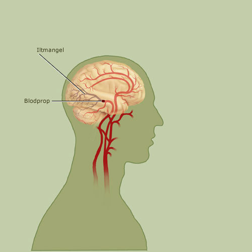 Illustration af blodprop i hjernen