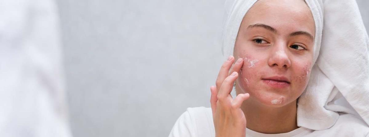 Ung pige smører creme på huden i ansigtet