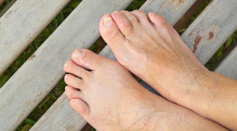 Svamp I Hud Og Negle