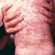 Røde og rundovale pletter på ryg efter smitte med mæslinger
