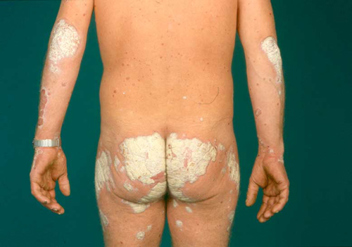 Møntagtig psoriasis