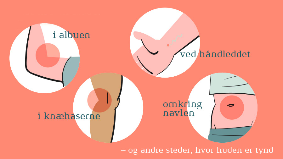 Illustration af hvor fnat typisk sidder