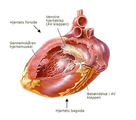 hjerteklapbetaendelse.jpg