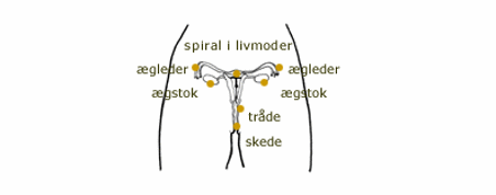 Spiralens placering i livmoderen