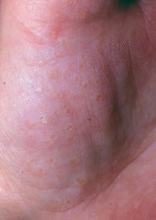 Kløende blærer i håndflade efter eksem