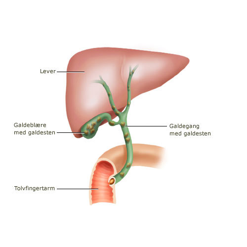 Illustration af galdesten i lever og tarm