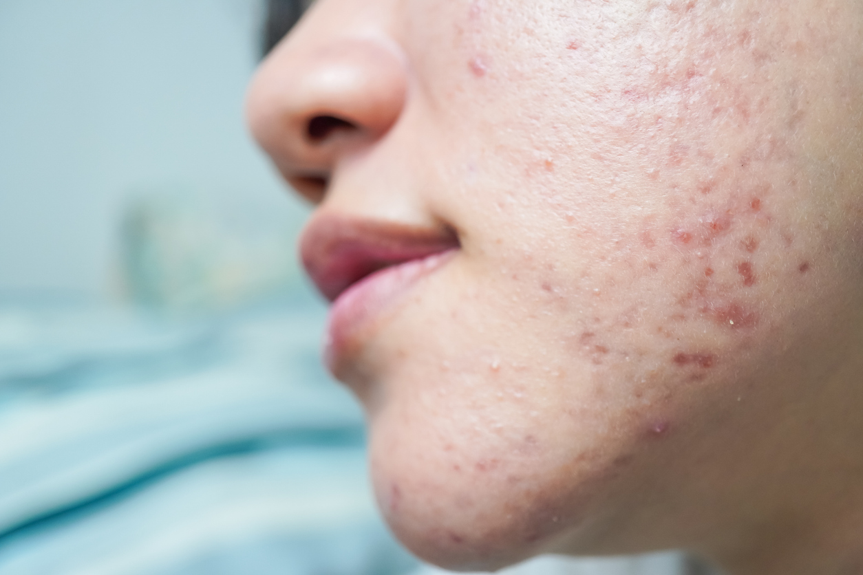 Acne Bumser Kind Kvinde Istock 2166326556