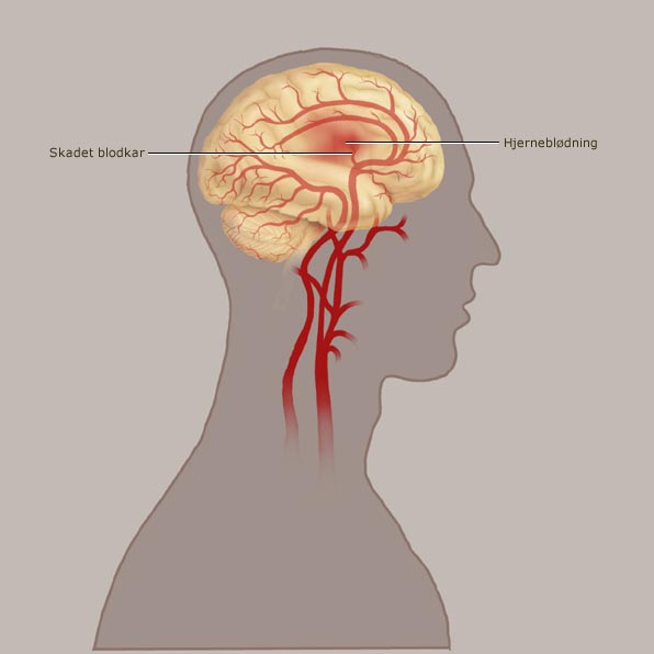 Illustration af hjerneblødning